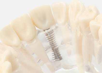 正確な診断で、患者様に負担の少ないインプラント治療を行います