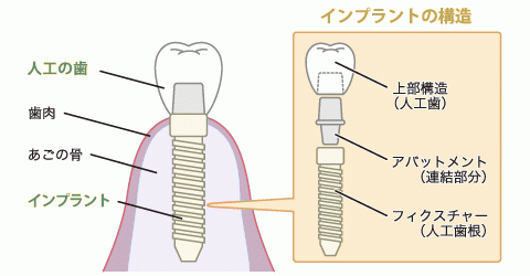 インプラントの埋入もお任せください