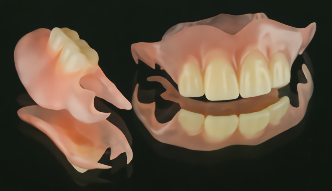 ノンクラスプデンチャー