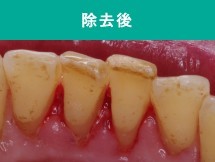 歯石除去後