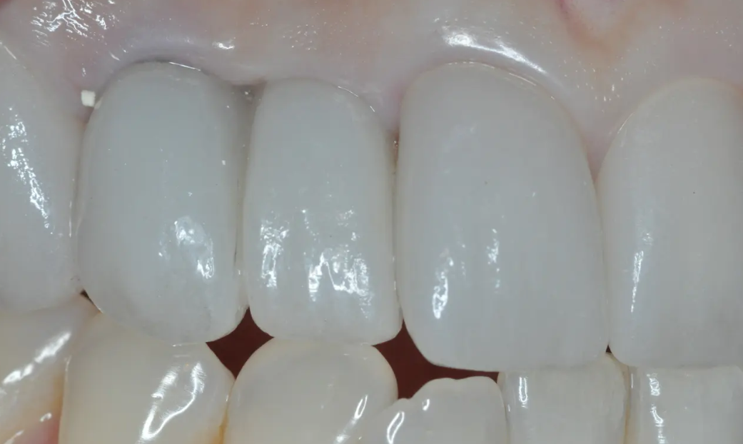 高度審美歯科治療