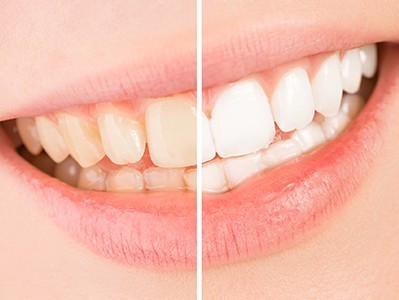 歯の変色には外側からの原因と内側からの原因があります