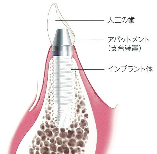 CT解析とガイドを用いた計画と手術で噛む機能の回復を図ります