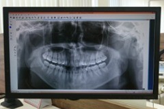 CTとシミュレーションソフトを活用し、安全性に配慮したインプラント治療を提供