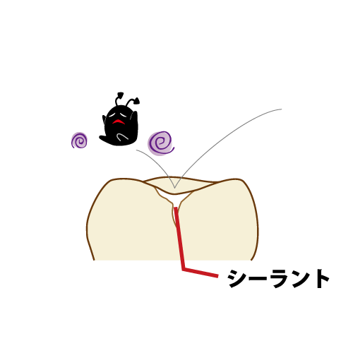 未来を守る乳歯ケアと予防治療