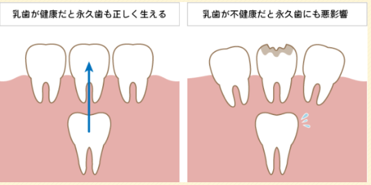 健康な歯並びは子どもの頃からの積み重ねで作られ、大人の歯がスムーズに生え変わりやすくなります。