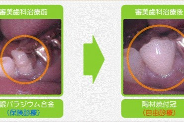 保険診療では使用できない素材を用いた歯冠修復・欠損補綴にも対応しています