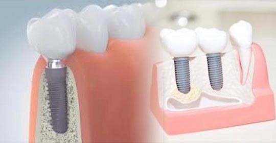 術後も定期的なメンテナンスを行い、長期的に安定したインプラントの維持を支援しています。