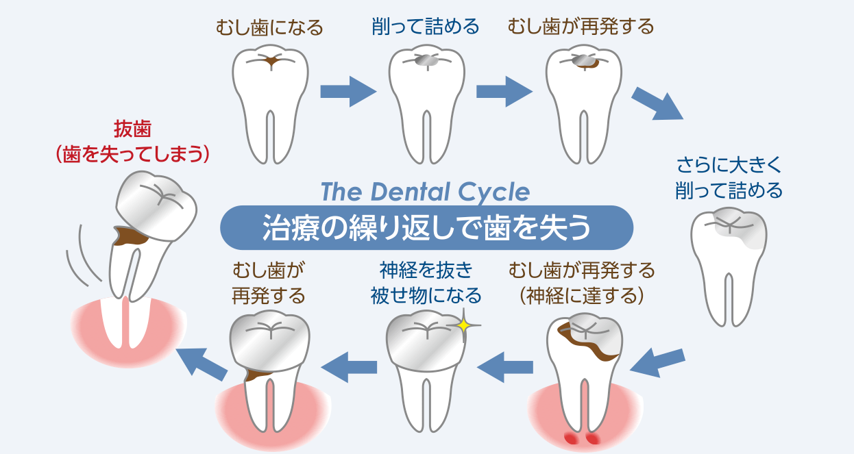 一度虫歯の治療をしたからといって、その歯はもう大丈夫ではありません