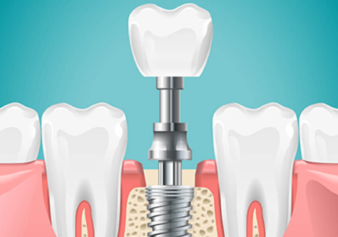 失った歯を自然に回復