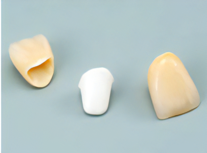 患者様の美しい笑顔と健康な歯をサポートし、自信を持てる日常生活を提供する治療法です。