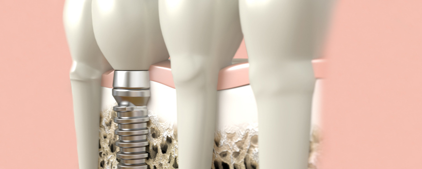 日本口腔インプラント学会 専門医による確実で安全なインプラント治療