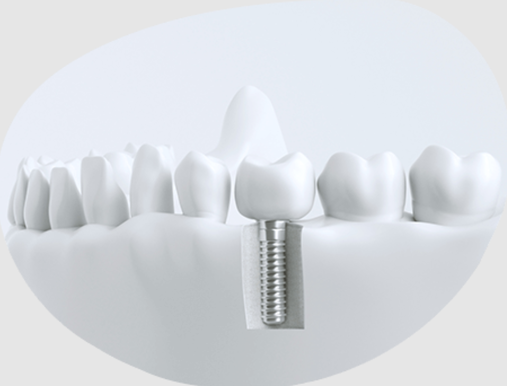 高品質な機器と確かな技術で、安全なインプラント治療を提供します