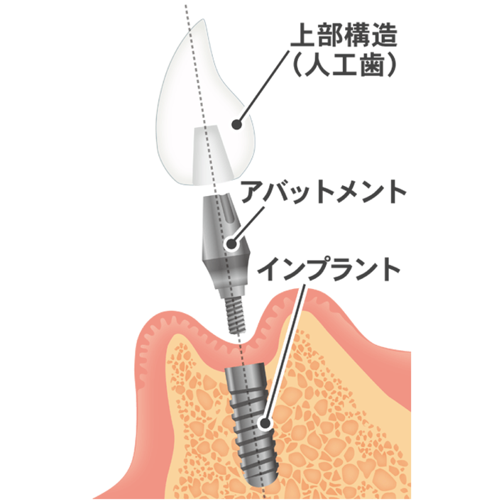 2回法と1回法の手術や骨造成に対応しています