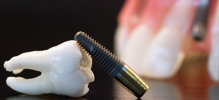 自然で美しいインプラントを提案します