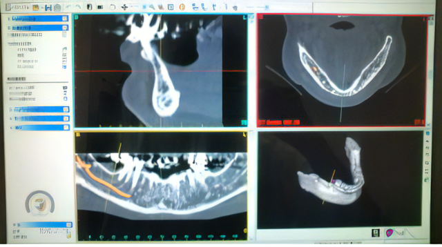 インプラントシュミレーション