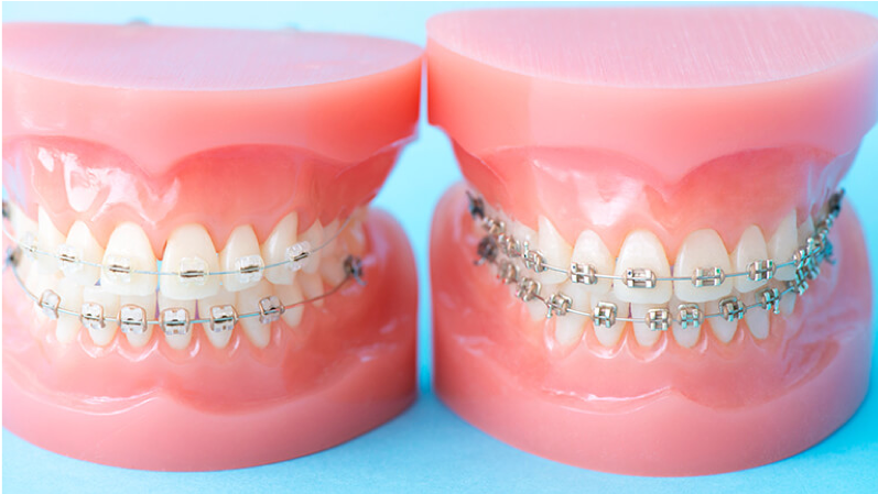 歯並びが気になる方はぜひご相談ください