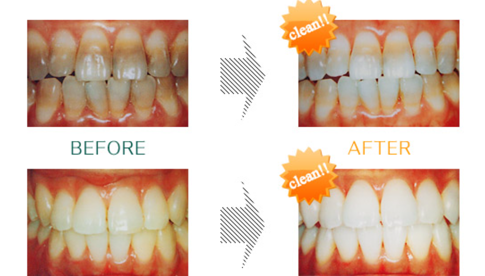 美しい口元で第一印象をアップさせましょう