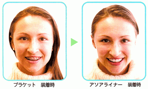目立たない矯正治療「アソアライナー」
