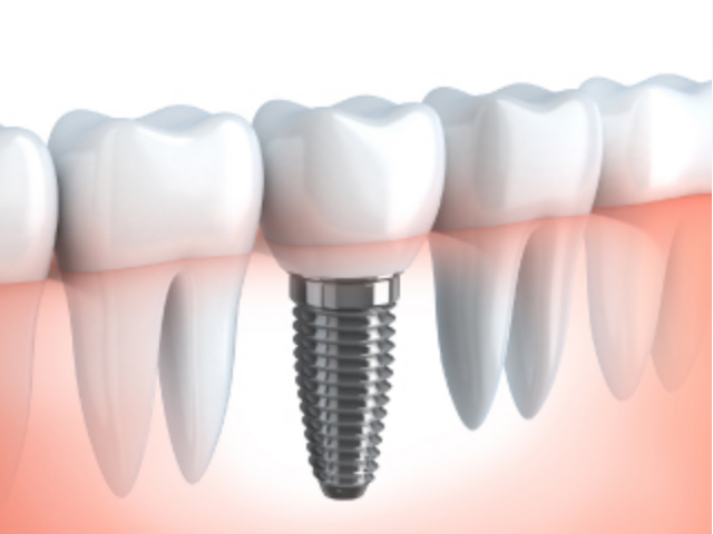 天然歯と同じ感覚で噛むことを楽しめるインプラント