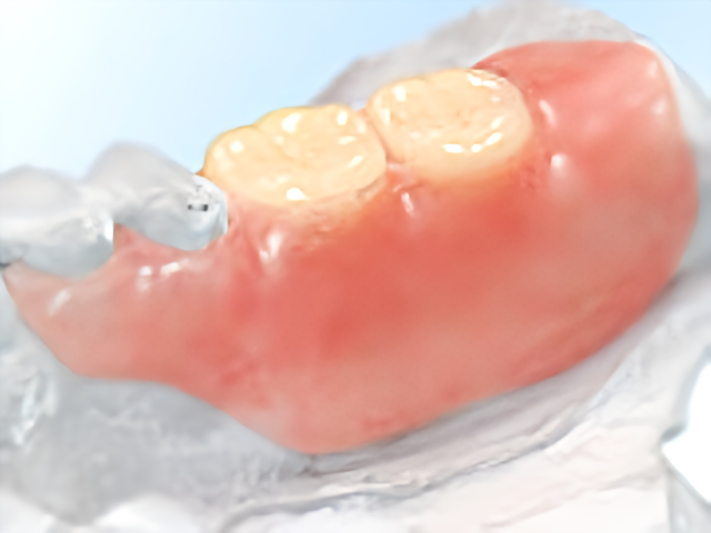 見た目と快適さを両立した義歯の提案