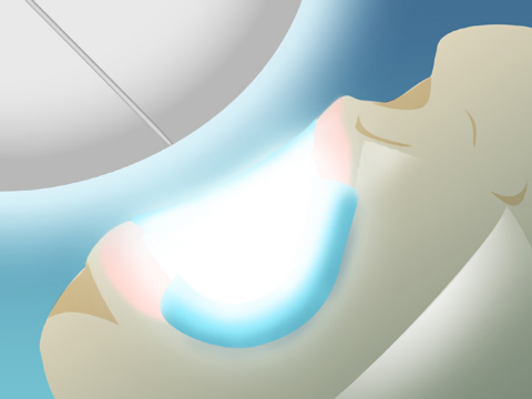 オフィスホワイトニングの治療イメージ