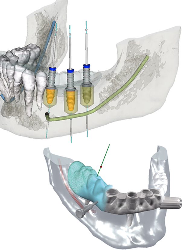 精度の高い安全なインプラント治療を行います