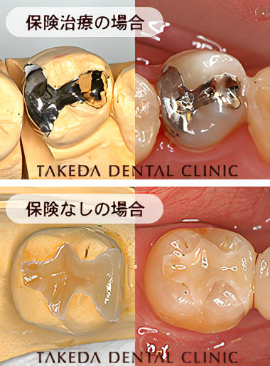 保険治療、保険なし治療の比較です