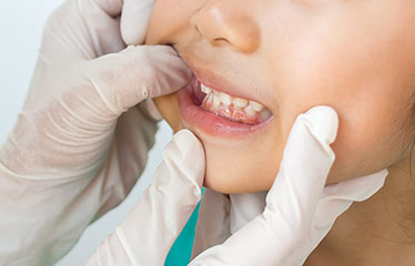 大切な歯を守りましょう