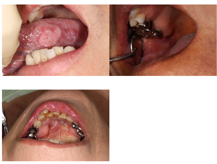 やましろ歯科口腔外科で発見された口腔がん