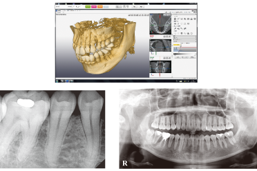 難しいとされる根管治療の歯科医院選びは慎重に行いましょう