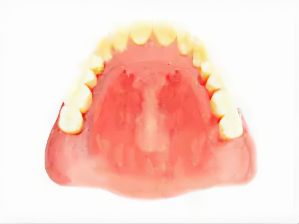 患者様の状況に応じた入れ歯を作成します