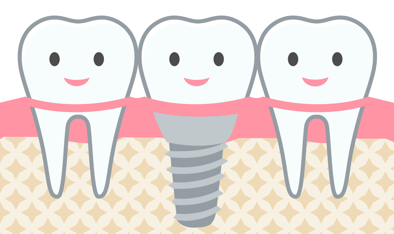抜けてしまった歯の代用として人工歯根を埋め込みます