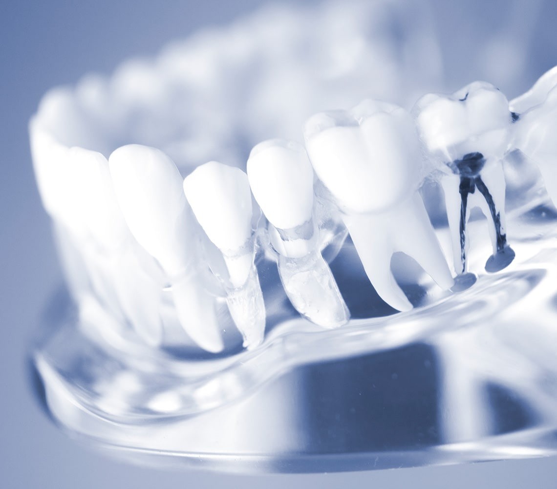 できる限り歯を残す選択を大切にし、根管治療に取り組んでいます。