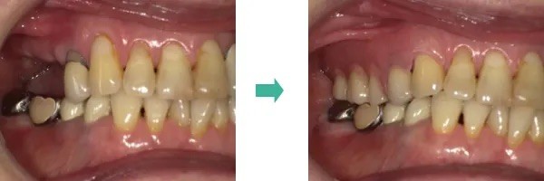 ノンクラスプデンチャー