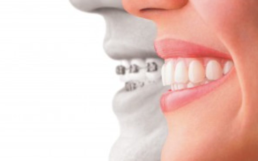 最新の矯正システムで快適な矯正治療を提供します