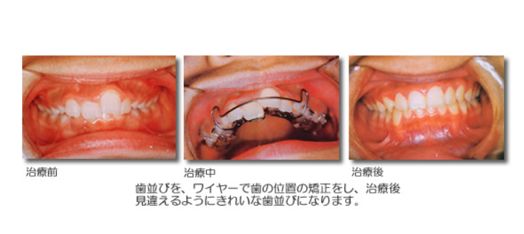 ワイヤーで歯並びを矯正します