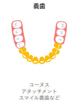 患者様に最適な入れ歯をご提案します