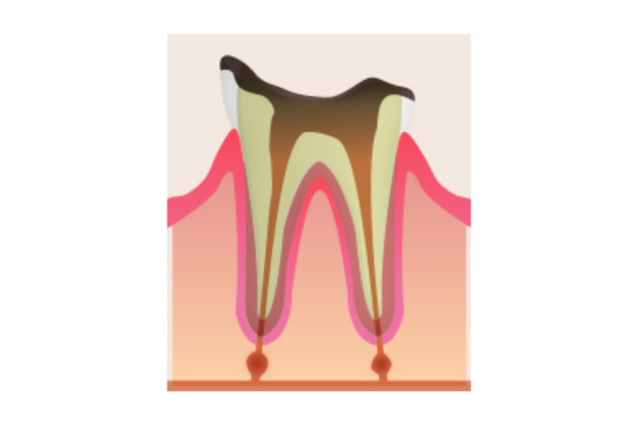 大規模な虫歯の治療の場合は根管治療が必要です