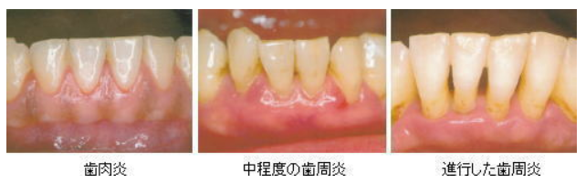 歯肉炎・歯周炎の治療写真