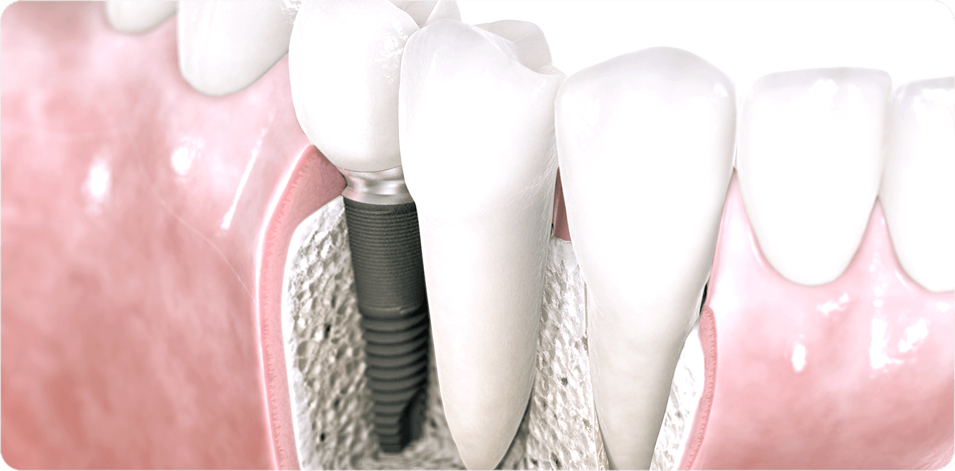 入れ歯に悩む方へ新たな選択肢