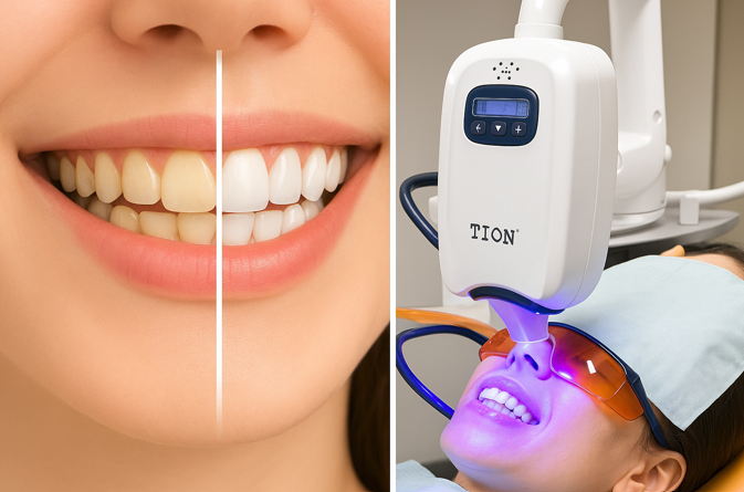 歯を白くすると同時に丈夫にします