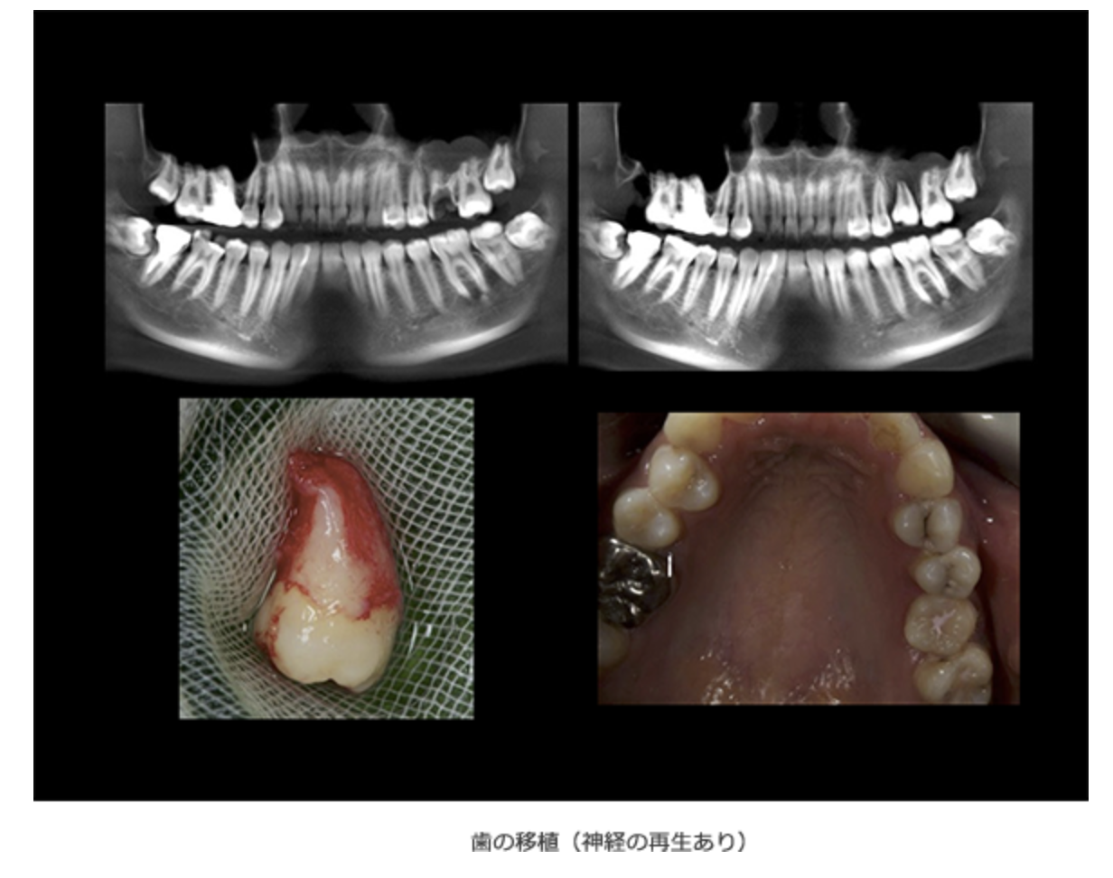歯を失った場合の新しい選択肢として「自家歯牙移植」をご提案しています