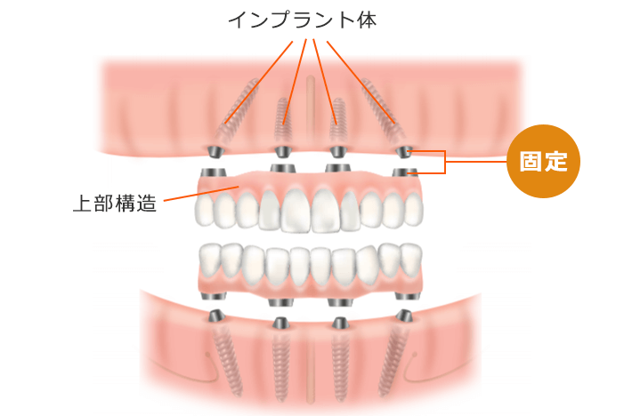 オールオン4による手術を取り扱っています