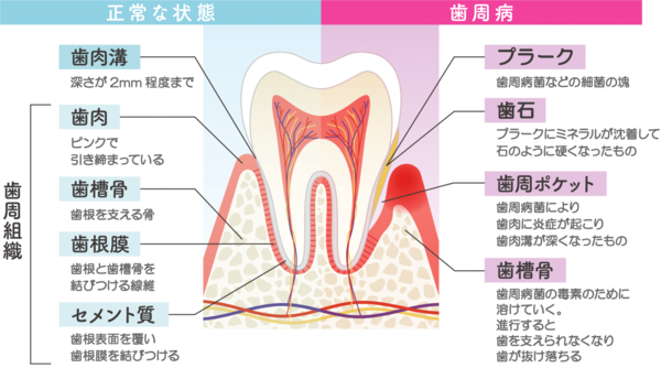 初期段階ではブラッシング中に出血が起こります
