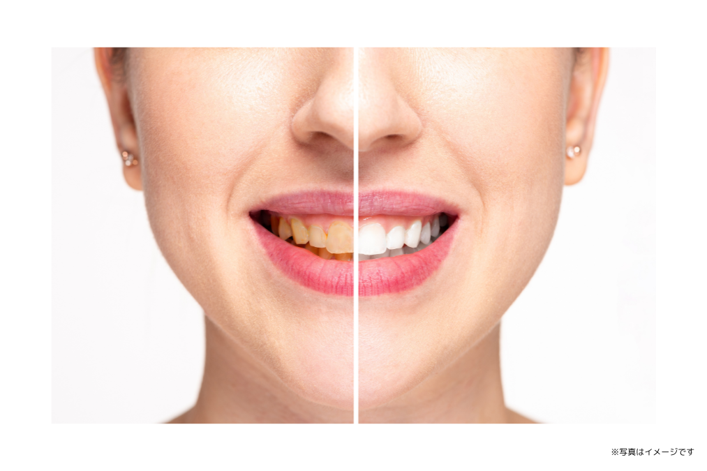 患者様の歯の状態やご希望に合わせたホワイトニングを提供しています