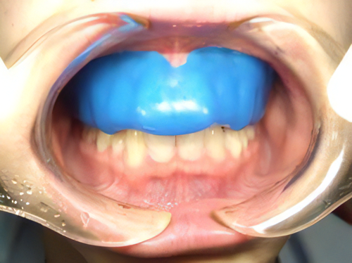 お口にフィットするマウスガードをお作りします