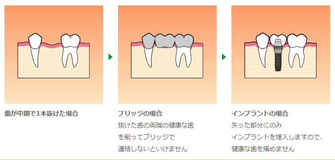 周囲の健康な歯に負担をかけずにお口の機能を回復します