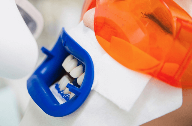 オフィスホワイトニングならば歯の白さをすぐに体感できます