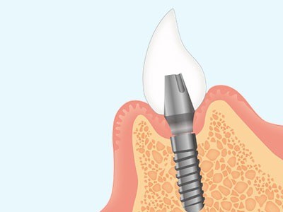 口腔全体のバランスを考慮しながら長期的な安定を見据えたインプラント治療を行っています。